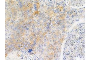 ABIN6256281 and ABIN6267651 at 1/100 staining human esophageal carcinoma by IHC-P.