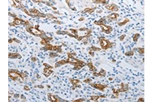 The image on the left is immunohistochemistry of paraffin-embedded Human gastric cancer tissue using ABIN7192809(TMEM8B Antibody) at dilution 1/15, on the right is treated with synthetic peptide. (TMEM8B antibody)