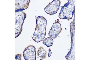 Immunohistochemistry of paraffin-embedded human colon carcinoma using cGAS Rabbit pAb (ABIN6134073, ABIN6143590, ABIN6143591 and ABIN6224360) at dilution of 1:50 (40x lens).