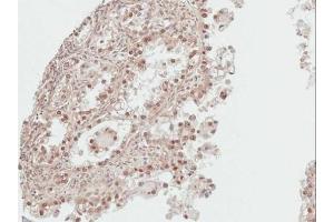 IHC-P Image Immunohistochemical analysis of paraffin-embedded human ovarian cancer, using DDI1, antibody at 1:100 dilution. (DDI1 antibody  (Center))
