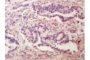 Formalin-fixed and paraffin embedded human colon carcinoma labeled with Anti-Plakophilin 2 Polyclonal Antibody, Unconjugated (ABIN1386389) at 1:200 followed by conjugation to the secondary antibody and DAB staining (Plakophilin 2 antibody  (AA 801-881))