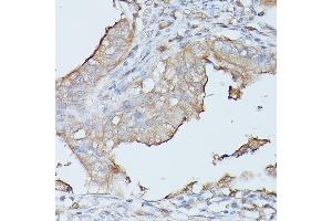 Immunohistochemistry of paraffin-embedded human oophoroma using CE Rabbit pAb (ABIN3015546, ABIN3015547, ABIN3015548 and ABIN6218802) at dilution of 1:100 (40x lens). (CEACAM1 antibody  (AA 300-430))