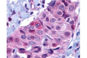 Immunohistochemistry of BBC3 in human breast carcinoma with BBC3 polyclonal antibody  at 10 ug/mL . (PUMA antibody  (N-Term))