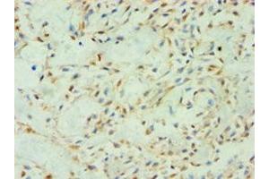Immunohistochemistry of paraffin-embedded human breast cancer using ABIN7170604 at dilution of 1:100 (Spindlin 2B antibody  (AA 1-258))