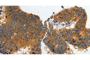 Immunohistochemistry of paraffin-embedded Human colon cancer tissue using GluR2 Polyclonal Antibody at dilution 1:70 (GRIA2 antibody)