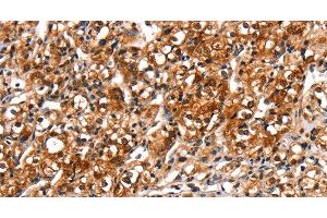 Immunohistochemistry of paraffin-embedded Human prostate cancer tissue using TRIM69 Polyclonal Antibody at dilution 1:40 (TRIM69 antibody)