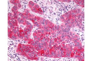 Anti-GPR17 antibody IHC of human Lung, Non-Small Cell Carcinoma. (GPR17 antibody  (N-Term))
