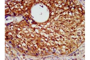 IHC image of ABIN7169341 diluted at 1:600 and staining in paraffin-embedded human cervical cancer performed on a Leica BondTM system. (SERPINB4 antibody  (AA 128-208))