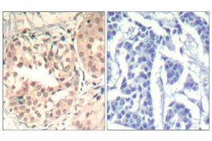 Immunohistochemical analysis of paraffin-embedded human breast carcinoma tissue using CDK6 (phospho-Tyr13) Antibody (E011542). (CDK6 antibody  (pTyr13))