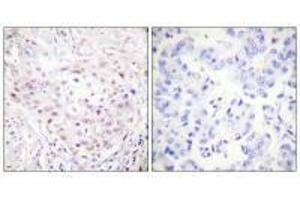 Immunohistochemistry analysis of paraffin-embedded human breast carcinoma tissue, using SENP3 antibody. (SENP3 antibody)