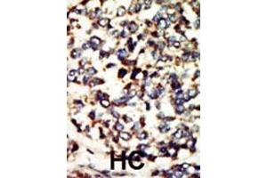 Formalin-fixed and paraffin-embedded human cancer tissue reacted with the primary antibody, which was peroxidase-conjugated to the secondary antibody, followed by DAB staining. (NEK7 antibody  (N-Term))