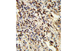 Formalin-fixed and paraffin-embedded human lung carcinoma reacted with PSMA7 Antibody , which was peroxidase-conjugated to the secondary antibody, followed by DAB staining. (PSMA7 antibody  (AA 100-126))