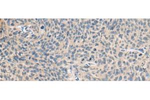 Immunohistochemistry of paraffin-embedded Human cervical cancer tissue using RNASE1 Polyclonal Antibody at dilution of 1:50(x200) (RNASE1 antibody)