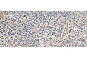Immunohistochemistry of paraffin-embedded Human cervical cancer tissue using RNASE1 Polyclonal Antibody at dilution of 1:50(x200)