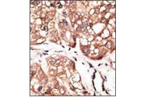 Formalin-fixed and paraffin-embedded human cancer tissue reacted with the primary antibody, which was peroxidase-conjugated to the secondary antibody, followed by AEC staining. (ATG4D antibody  (AA 227-257))