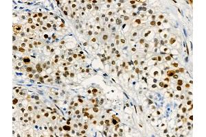 Phospho-EZH2 (Thr416) Antibody at 1/100 staining Human pancreatic cancer by IHC-P.