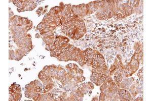 IHC-P Image Immunohistochemical analysis of paraffin-embedded human lung SCC, using Dishevelled 2, antibody at 1:100 dilution.