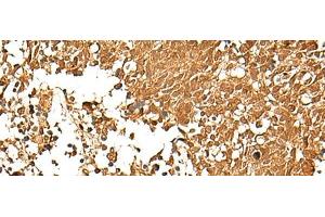 Immunohistochemistry of paraffin-embedded Human lung cancer tissue using TCF7 Polyclonal Antibody at dilution of 1:30(x200) (TCF7 antibody)