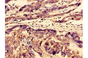 Immunohistochemistry of paraffin-embedded human gastric cancer using ABIN7175699 at dilution of 1:100 (WDFY3 antibody  (AA 1-100))