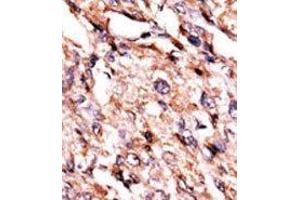 Formalin-fixed and paraffin-embedded human cancer tissue reacted with the primary antibody, which was peroxidase-conjugated to the secondary antibody, followed by AEC staining. (BCKDK antibody  (Middle Region))