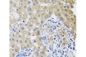 Immunohistochemistry of paraffin-embedded Human liver damage using RHOB Polyclonal Antibody at dilution of 1:100 (40x lens). (RHOB antibody)