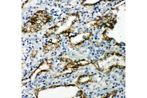Anti-Aquaporin 4 antibody, IHC(P) IHC(P): Human Lung Cancer Tissue (Aquaporin 4 antibody  (C-Term))