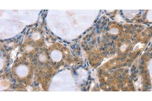 Immunohistochemistry of paraffin-embedded Human thyroid cancer using GNAT3 Polyclonal Antibody at dilution of 1:35 (GNAT3 antibody)