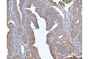 IHC analysis of MUC1 using anti-MUC1 antibody (ABIN7602711). (MUC1 antibody  (AA 979-1095))