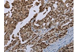 The image on the left is immunohistochemistry of paraffin-embedded Human ovarian cancer tissue using ABIN7191347(MAGEB18 Antibody) at dilution 1/20, on the right is treated with synthetic peptide. (MAGEB18 antibody)