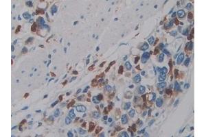 Detection of PTPRQ in Human Stomach cancer Tissue using Polyclonal Antibody to Protein Tyrosine Phosphatase Receptor Type Q (PTPRQ)