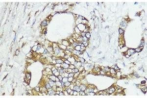 Immunohistochemistry of paraffin-embedded Human lung cancer using SOCS6 Polyclonal Antibody at dilution of 1:100 (40x lens). (SOCS6 antibody)
