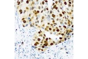 Immunohistochemical analysis of DDX39B staining in human prostate cancer formalin fixed paraffin embedded tissue section. (DDX39B antibody)