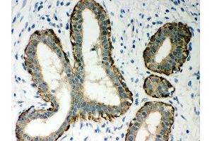 IHC-P: Ovalbumin antibody testing of human breast cancer tissue (Ovalbumin antibody  (AA 1-350))