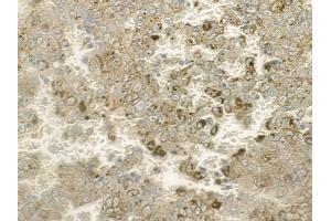 ABIN6260792 and ABIN6273099 at 1/100 staining human melanoma by IHC-P.