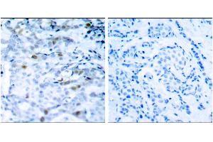 Immunohistochemical analysis of paraffin-embedded breast carcinoma, using CDC2(Phospho-Thr161) Antibody. (CDK1 antibody  (pThr161))