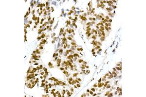 Immunohistochemistry of paraffin-embedded human lung cancer using RBM3 Rabbit mAb (ABIN7270084) at dilution of 1:25 (40x lens). (RBM3 antibody)