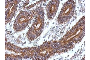 IHC-P Image Immunohistochemical analysis of paraffin-embedded human colon carcinoma, using CCDC37, antibody at 1:500 dilution. (CCDC37 antibody  (N-Term))