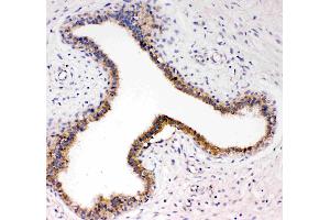 Anti-TrkC antibody, IHC(P): Human Mammary Cancer Tissue (NTRK3 antibody  (N-Term))