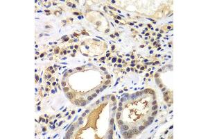 Immunohistochemistry of paraffin-embedded human gastric cancer using PSME2 antibody at dilution of 1:100 (x40 lens). (PSME2 antibody)