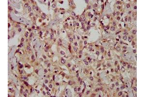 IHC image of  diluted at 1:1200 and staining in paraffin-embedded human liver cancer performed on a Leica BondTM system. (CD133 antibody  (AA 508-792))