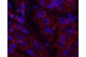 Immunofluorescence analysis of Human stomach cancer tissue using Catenin beta Monoclonal Antibody at dilution of 1:200. (beta Catenin antibody)