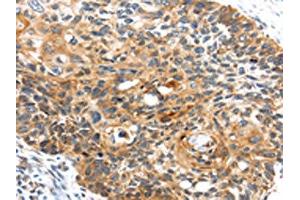 The image on the left is immunohistochemistry of paraffin-embedded Human esophagus cancer tissue using ABIN7127958(CENPM Antibody) at dilution 1/30, on the right is treated with fusion protein. (CENPM antibody)