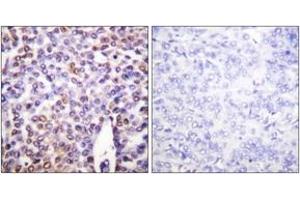 Immunohistochemistry analysis of paraffin-embedded human breast carcinoma tissue, using Histone H4 (Ab-16) Antibody. (Histone H4 antibody  (AA 15-64))