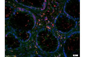 Formalin-fixed and paraffin-embedded human colon carcinoma labeled with Rabbit Anti-Von Willebrand Factor Polyclonal Antibody, Unconjugated(ABIN1714578) 1:200, overnight at 4 °C, The secondary antibody was Goat Anti-Rabbit IgG, Cy3 conjugated used at 1:200 dilution for 40 minutes at 37 °C. (VWF antibody  (AA 1651-1800))