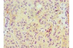 Immunohistochemistry of paraffin-embedded human liver cancer using ABIN7155322 at dilution of 1:100 (HDAC6 antibody  (AA 160-470))