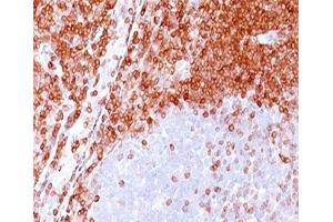 IHC testing of formalin-paraffin non-Hodgkin's lymphoma stained with Bcl-2 antibody (100/D5). (Bcl-2 antibody)
