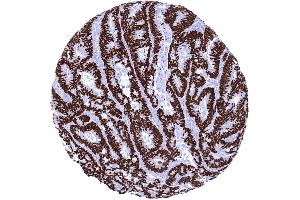 Colon Colorectal adenocarcinoma showing strong SATB2 immunostaining of all tumor cells (Recombinant SATB2 antibody  (AA 200-300))