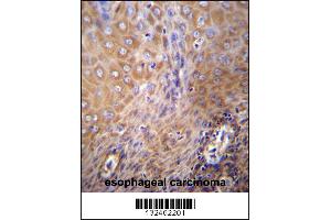SLC6A14 Antibody immunohistochemistry analysis in formalin fixed and paraffin embedded human esophageal carcinoma followed by peroxidase conjugation of the secondary antibody and DAB staining.