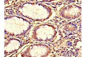 Immunohistochemistry of paraffin-embedded human colon cancer using ABIN7164582 at dilution of 1:100 (C12orf65 antibody  (AA 36-166))