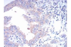 Immunohistochemical analysis of paraffin-embedded endometrial cancer tissues using FGFR3 mouse mAb with DAB staining.
